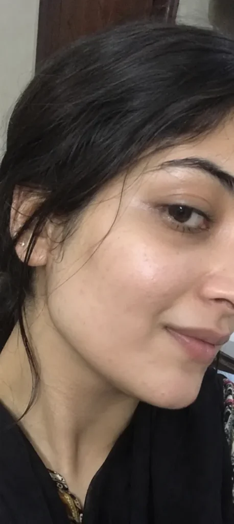 Acne Marks after