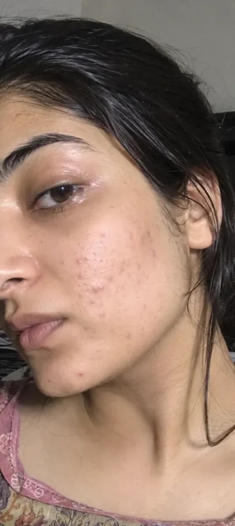 Acne Marks before