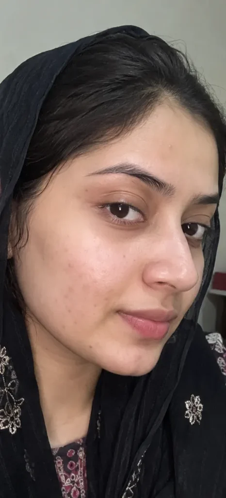 Acne Scars & Dark Marks after