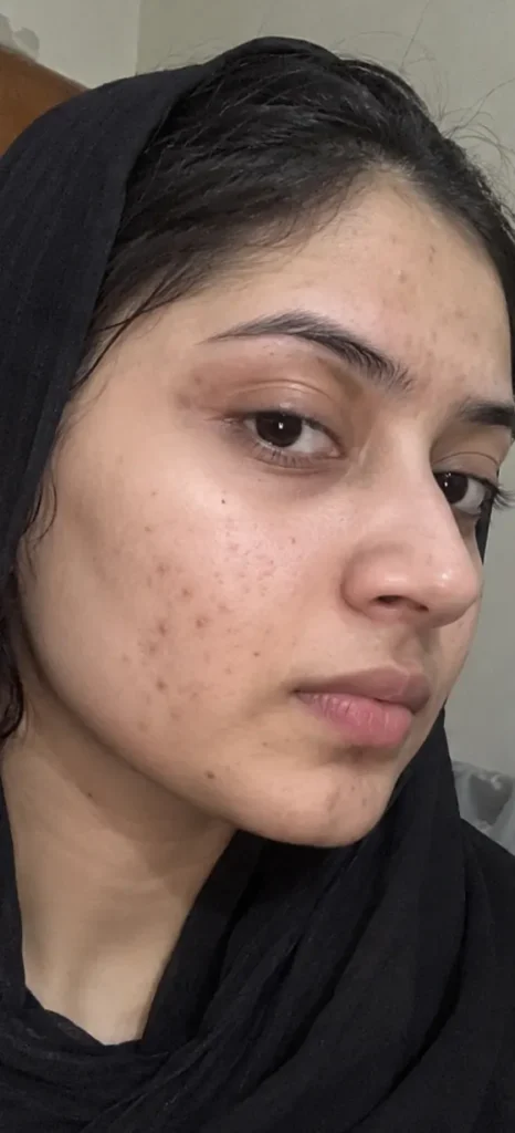 Acne Scars & Dark Marks before