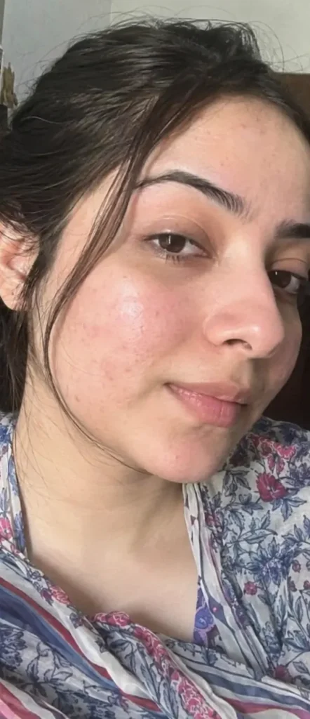 Active Acne after