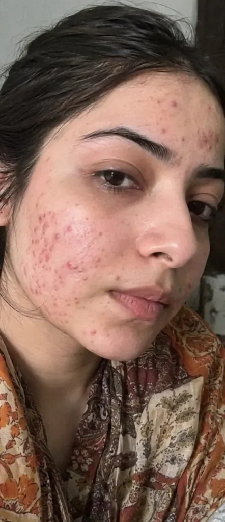 Active Acne before