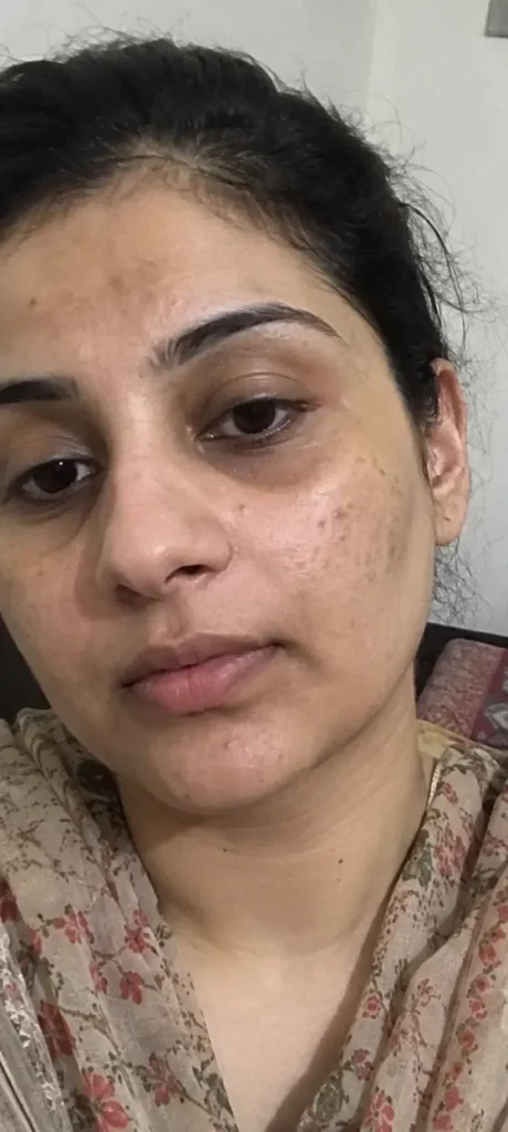 Dark Spots & Dull Skin before