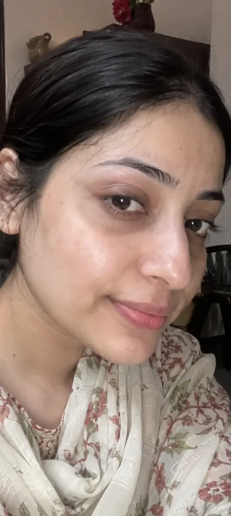 Freckles & Uneven Tone after