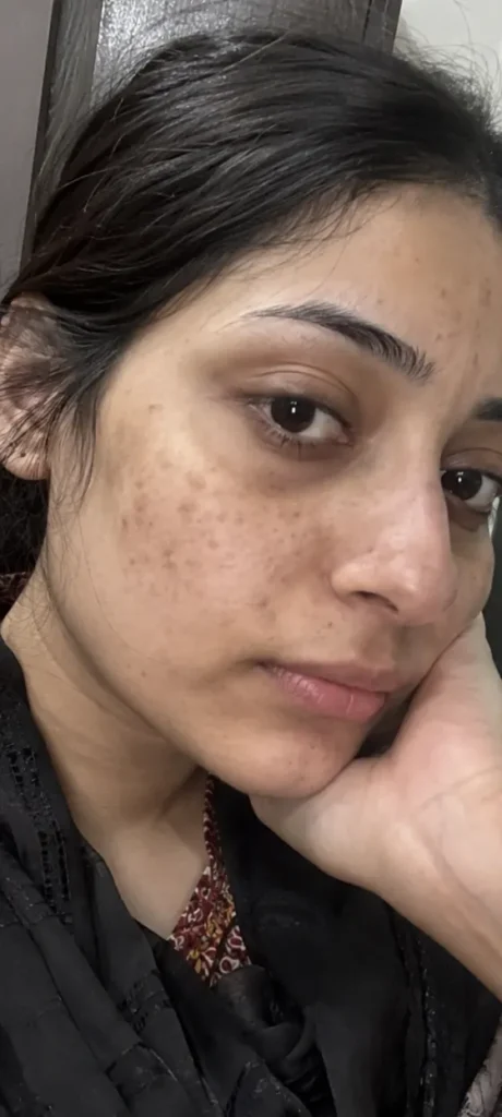 Freckles & Uneven Tone before