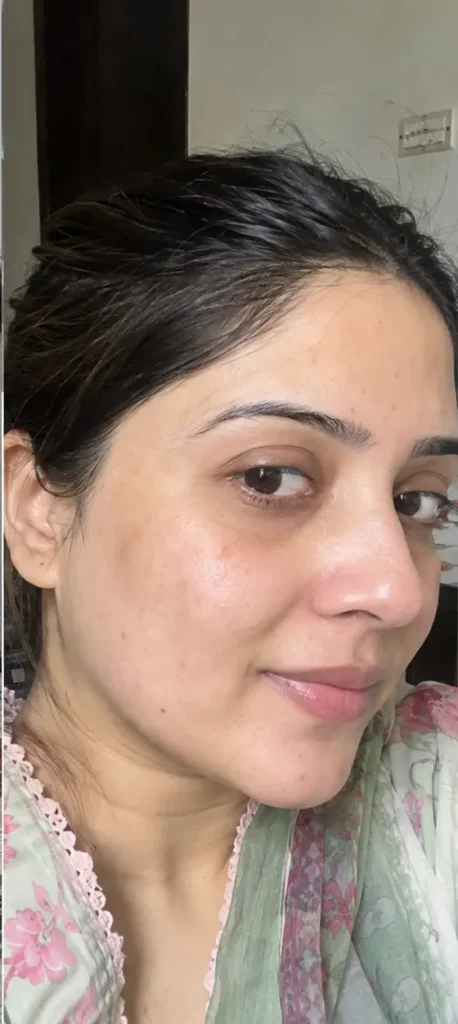 Melasma & Pigmentation after
