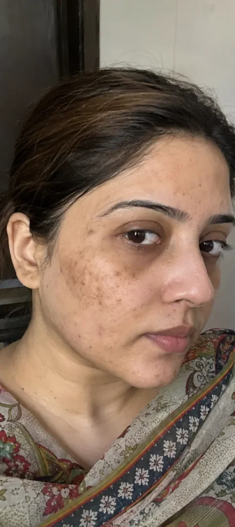 Melasma & Pigmentation before