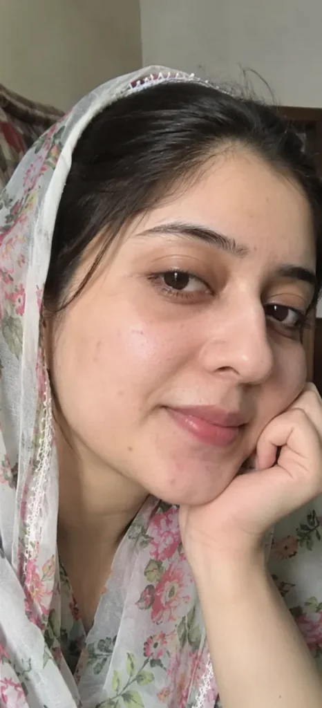 Post-Acne Spots after