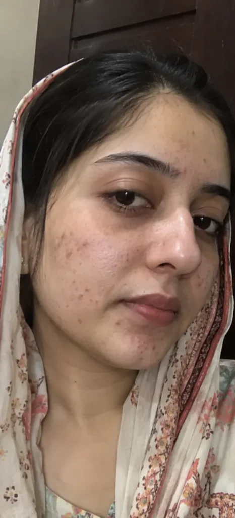 Post-Acne Spots before